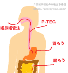 胃ろう(ペグ)・経鼻胃管栄養・中心静脈栄養の違いと注意点