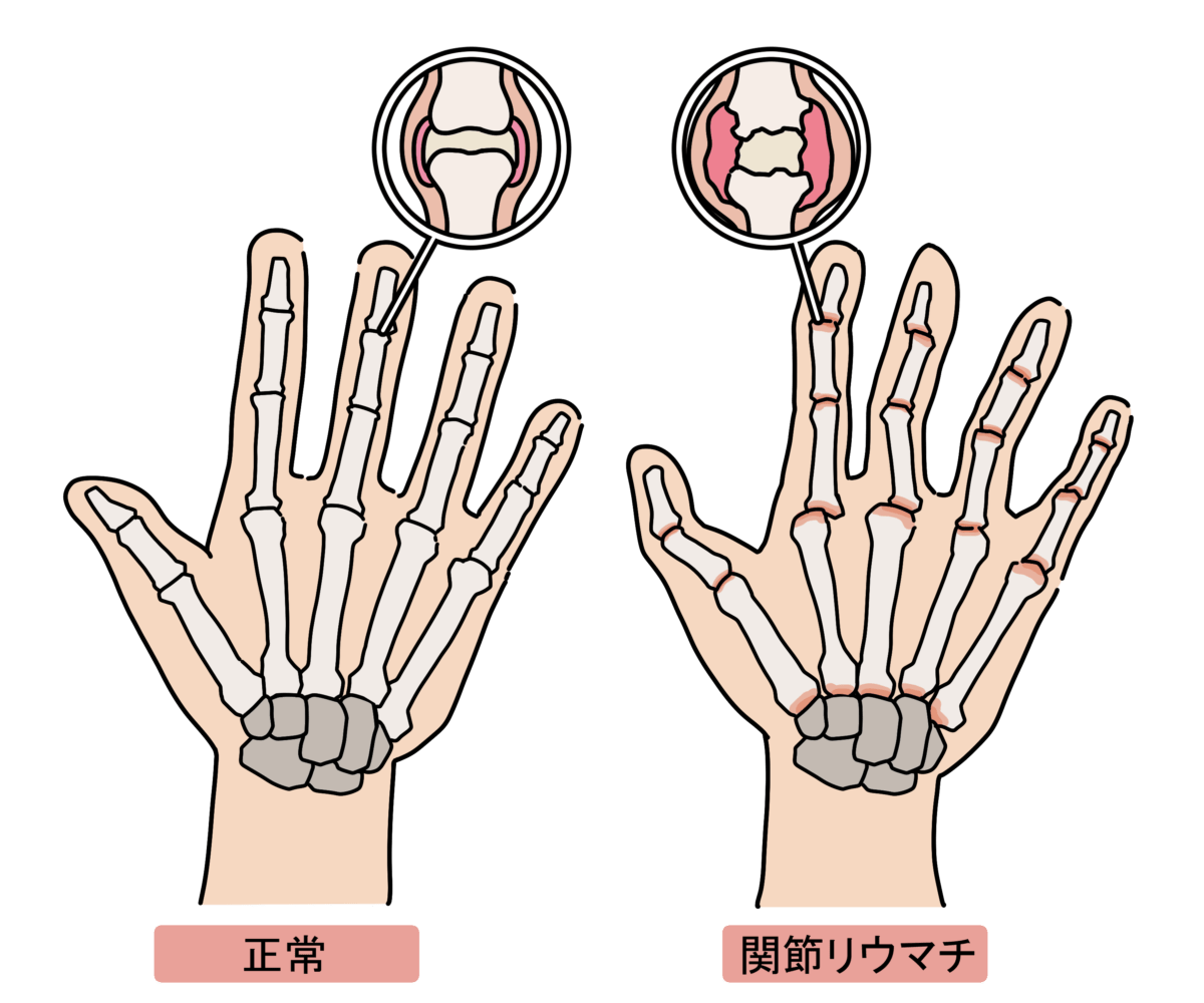 関節リウマチの病態と疾患